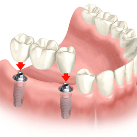 dental-bridge