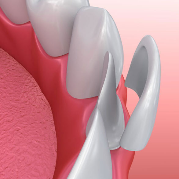 dental-veneers