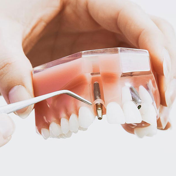 dental implants