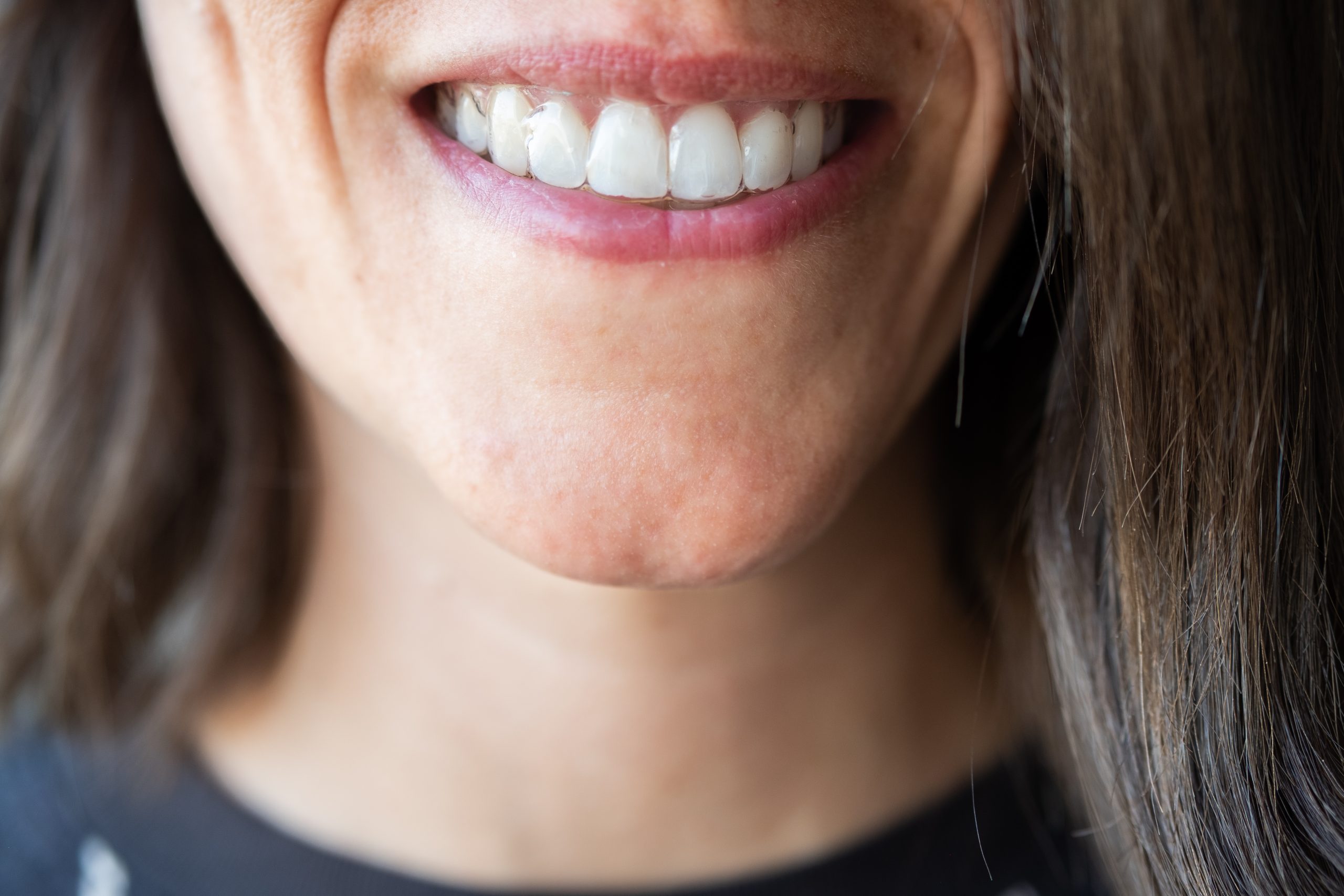 Invisalign Promotion!⁣ We are super excited to be extending up to